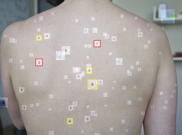 جِلد کے کینسر کی تشخیص کرنے والا جدید اے آئی ماڈل متعارف کروا دیا گیا