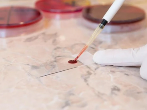 خون کے ٹیسٹ سے متعدد کینسرز کا قبل از وقت پتہ لگایا جاسکتا ہے، تحقیق