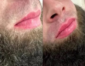 روسی مردوں میں لِپ فِلرز مقبولیت حاصل کرنے لگے