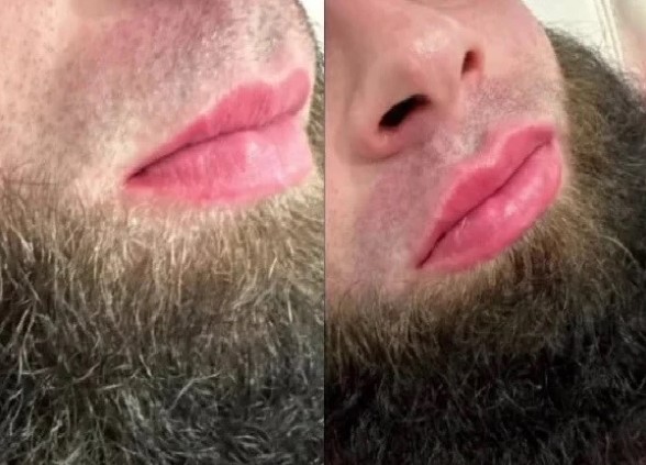 روسی مردوں میں لِپ فِلرز مقبولیت حاصل کرنے لگے