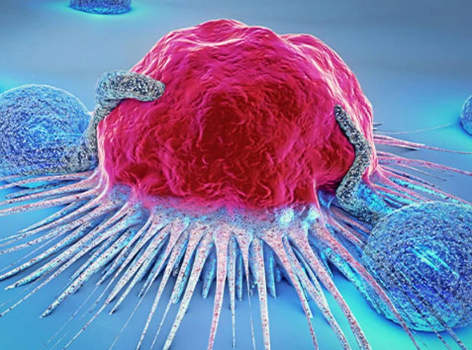 مثانے کے کینسر کے نئے علاج میں اہم پیش رفت